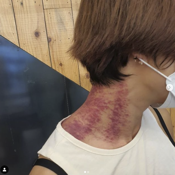 Comedian Kim Hye-Seon, who married a German man, has a deep blue bruise on her neck ... Has she been beaten?