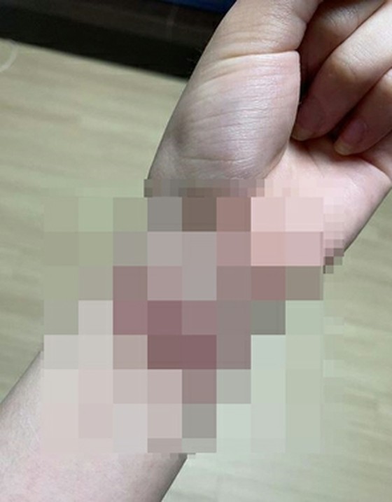 Kwon Mina revealed the reason of leaving "AOA" because there was bullying from a member and posts scars of suicide attempt on SNS